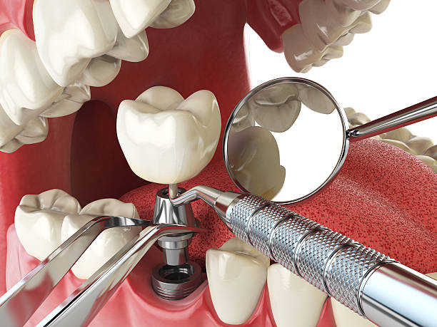 Best Emergency Wisdom Teeth Removal in South Haven, IN